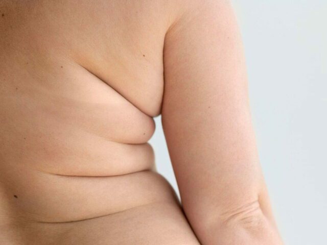 Παχυσαρκία στην Ελλάδα