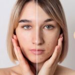 Εύκολη Απαλλαγή από την Ακμή