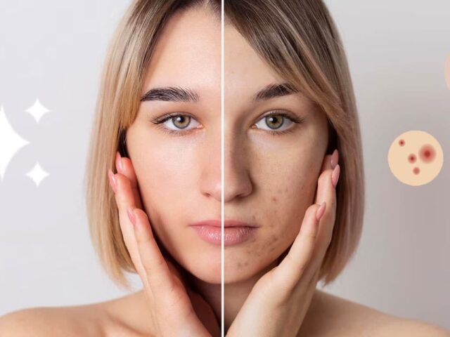 Εύκολη Απαλλαγή από την Ακμή