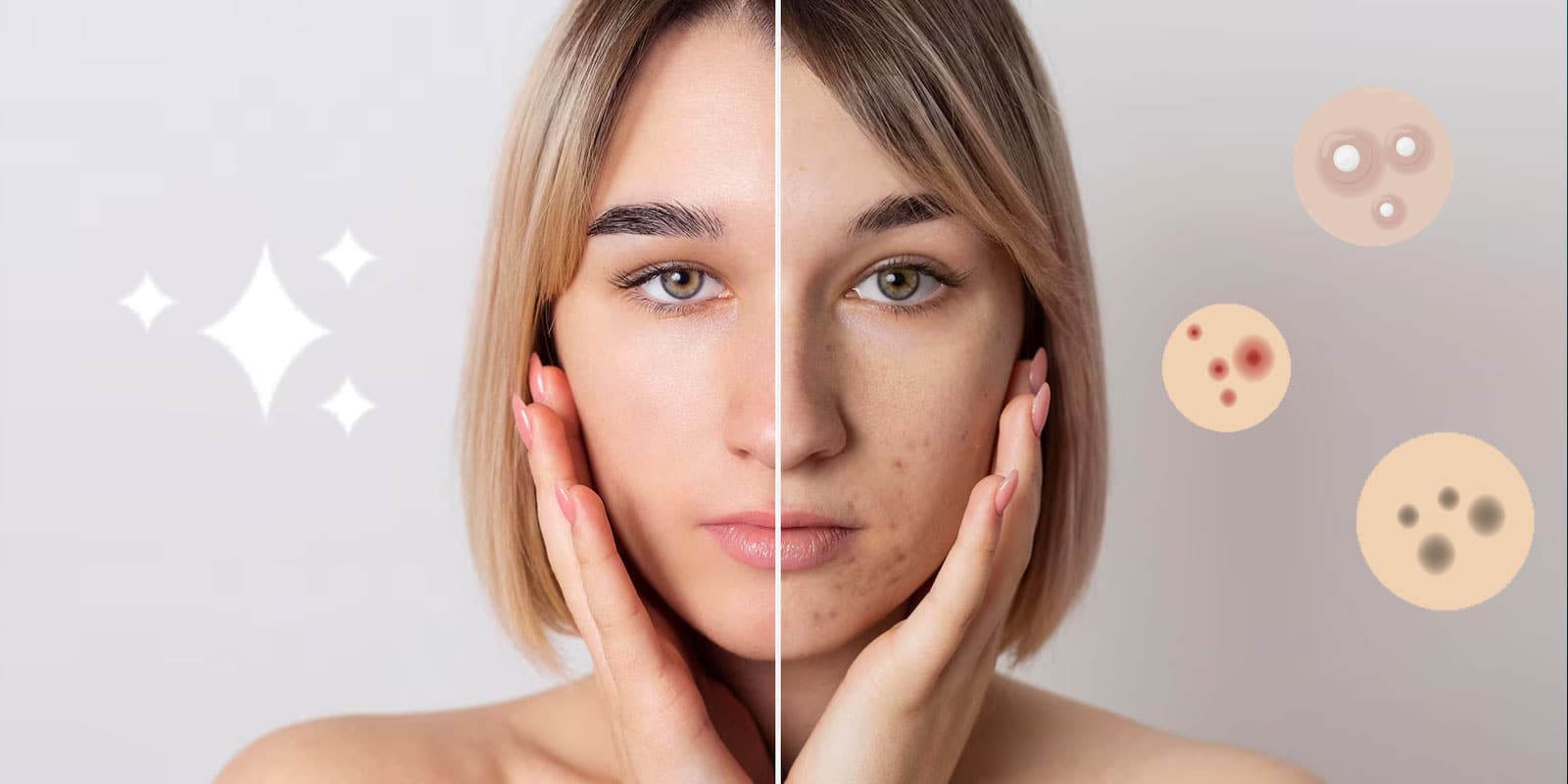 Εύκολη Απαλλαγή από την Ακμή